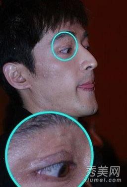 脸部疤痕的明星,探寻脸部疤痕背后的故事